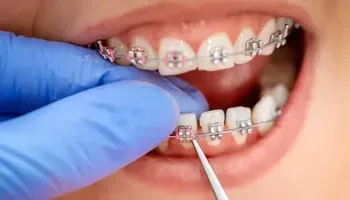 Хто такий лікар ортодонт? Як виправити неправильний прикус?